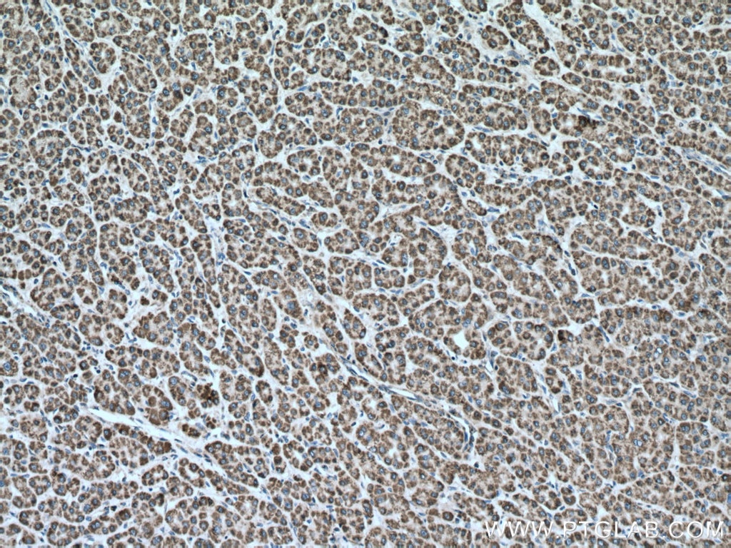 Immunohistochemistry (IHC) staining of human liver cancer tissue using Cytochrome c Monoclonal antibody (66264-1-Ig)