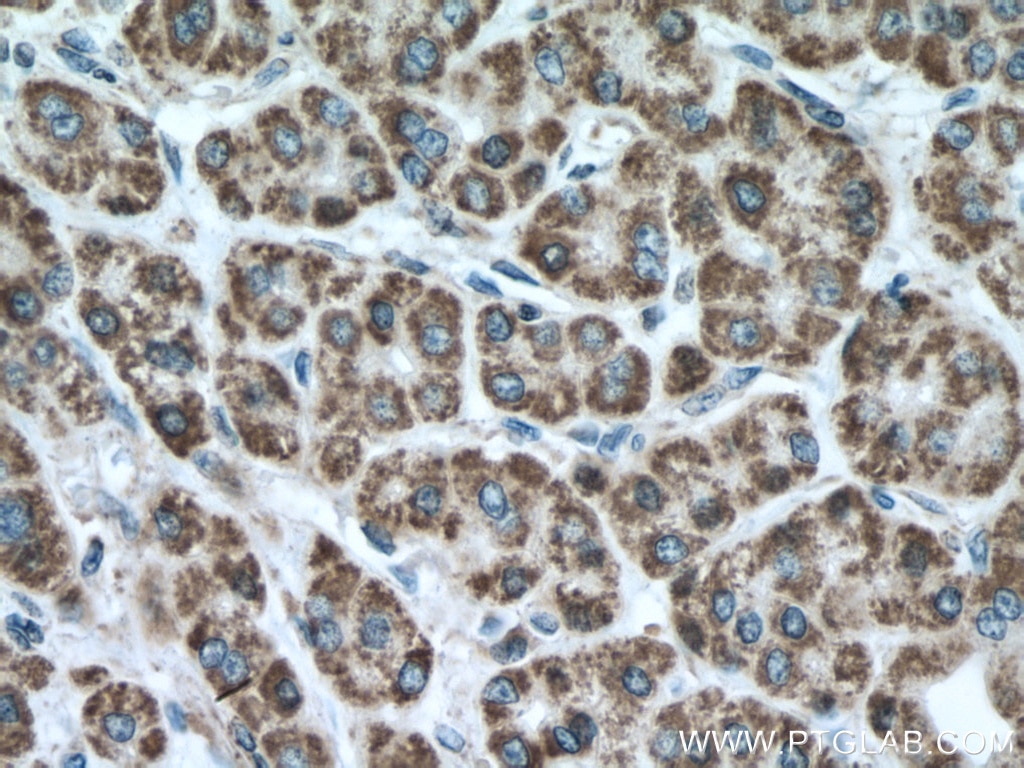 Immunohistochemistry (IHC) staining of human liver cancer tissue using Cytochrome c Monoclonal antibody (66264-1-Ig)