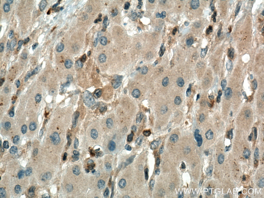 Immunohistochemistry (IHC) staining of human liver cancer tissue using Cytohesin 2 Monoclonal antibody (67185-1-Ig)