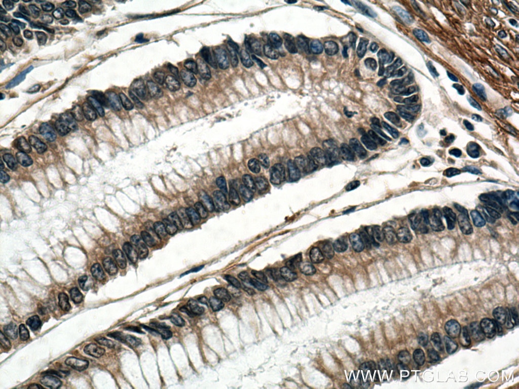 Immunohistochemistry (IHC) staining of human colon cancer tissue using Cytohesin 2 Monoclonal antibody (67185-1-Ig)