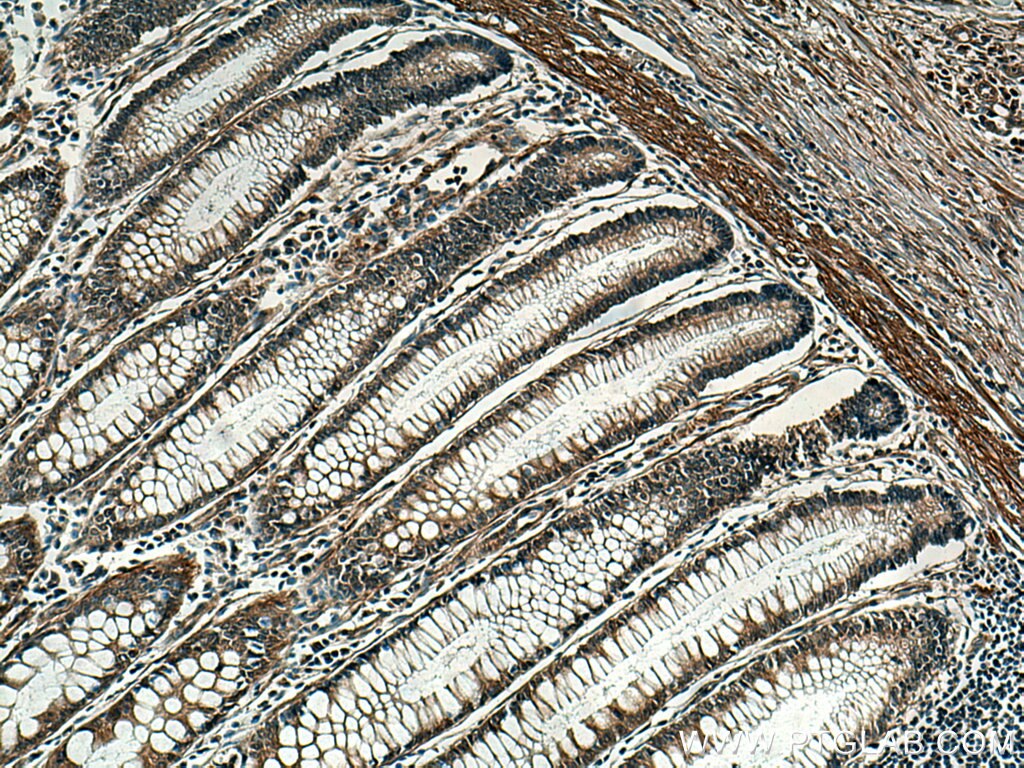 Immunohistochemistry (IHC) staining of human colon cancer tissue using Cytohesin 2 Monoclonal antibody (67185-1-Ig)