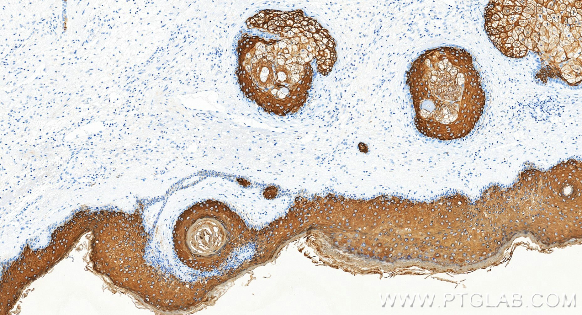 Immunohistochemistry (IHC) staining of human skin tissue using Cytokeratin 10 Recombinant monoclonal antibody (86324-1-RR)