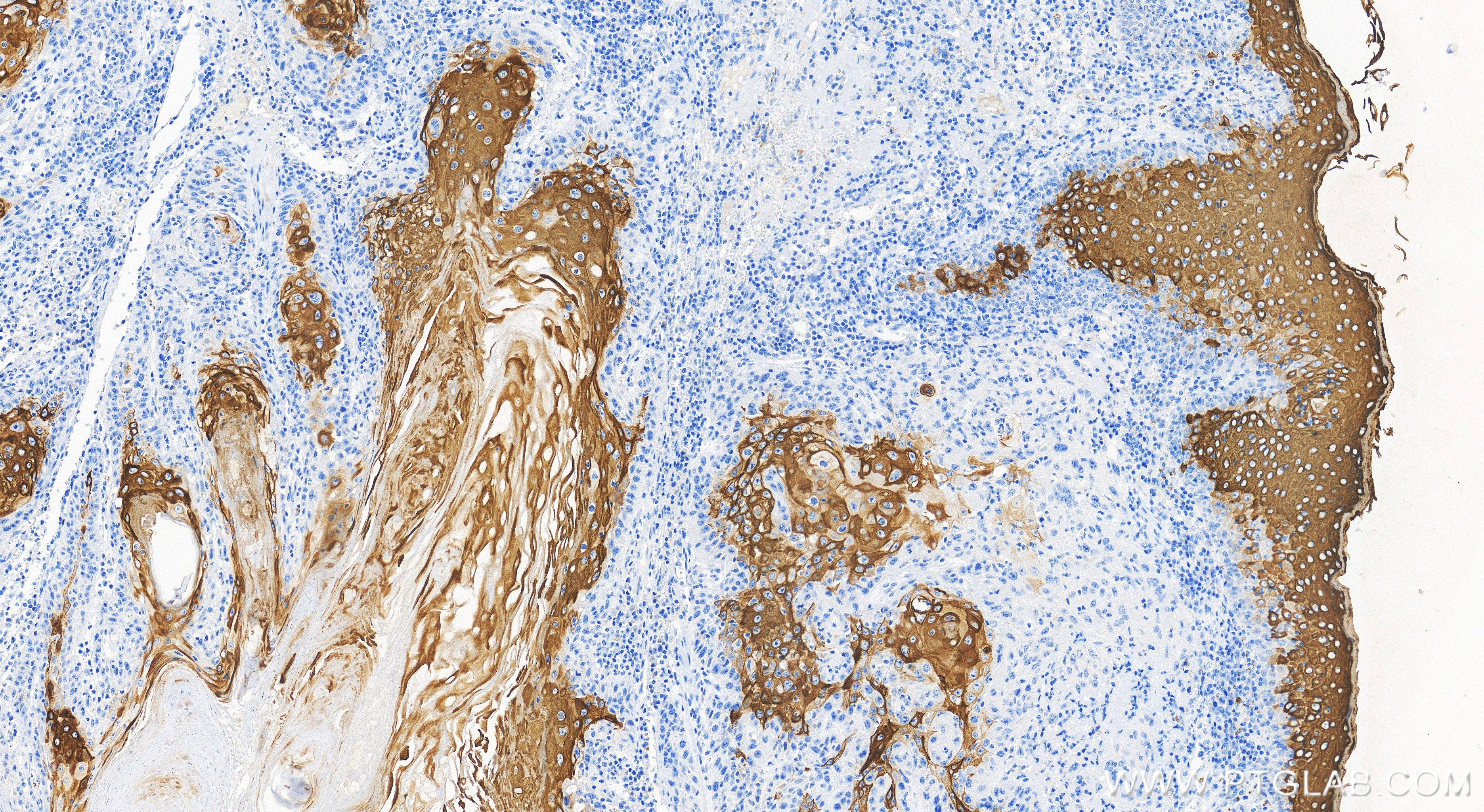 Immunohistochemistry (IHC) staining of human skin cancer tissue using Cytokeratin 10 Recombinant antibody (86324-1-RR)