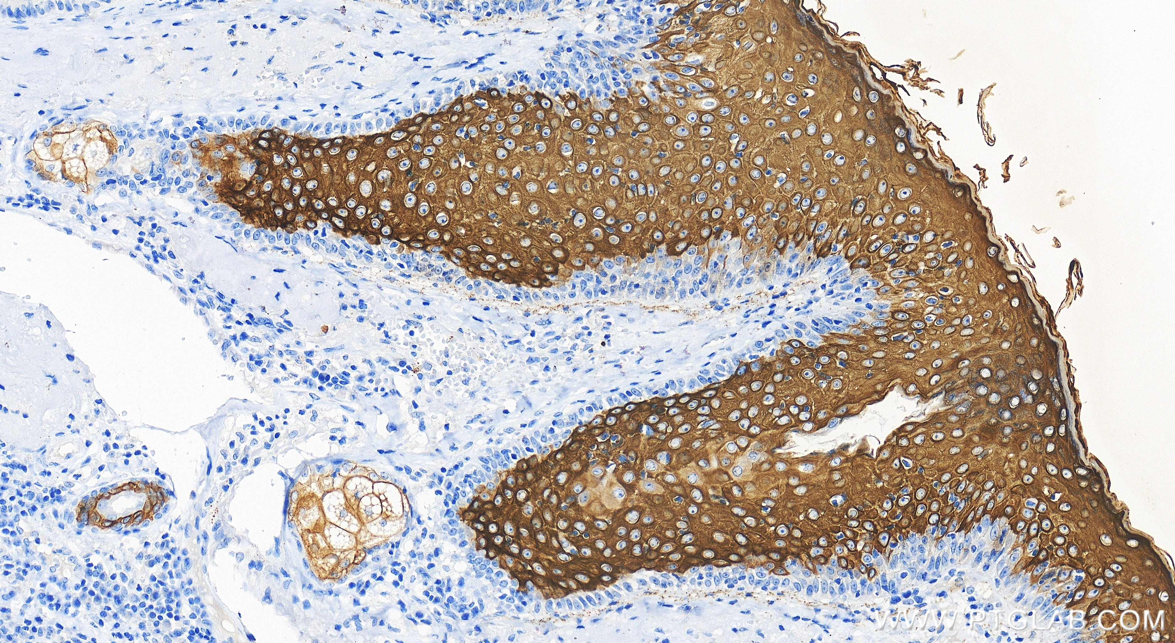 Immunohistochemistry (IHC) staining of human skin cancer tissue using Cytokeratin 10 Recombinant antibody (86324-1-RR)