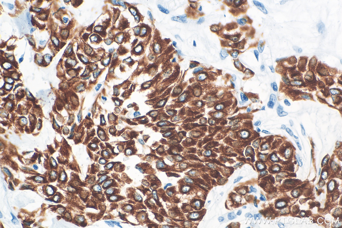 Immunohistochemistry (IHC) staining of human urothelial carcinoma tissue using Cytokeratin 13 Recombinant antibody (83058-1-RR)