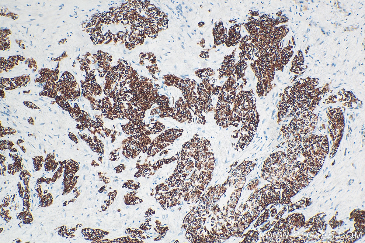 Immunohistochemistry (IHC) staining of human urothelial carcinoma tissue using Cytokeratin 13 Recombinant antibody (83058-1-RR)