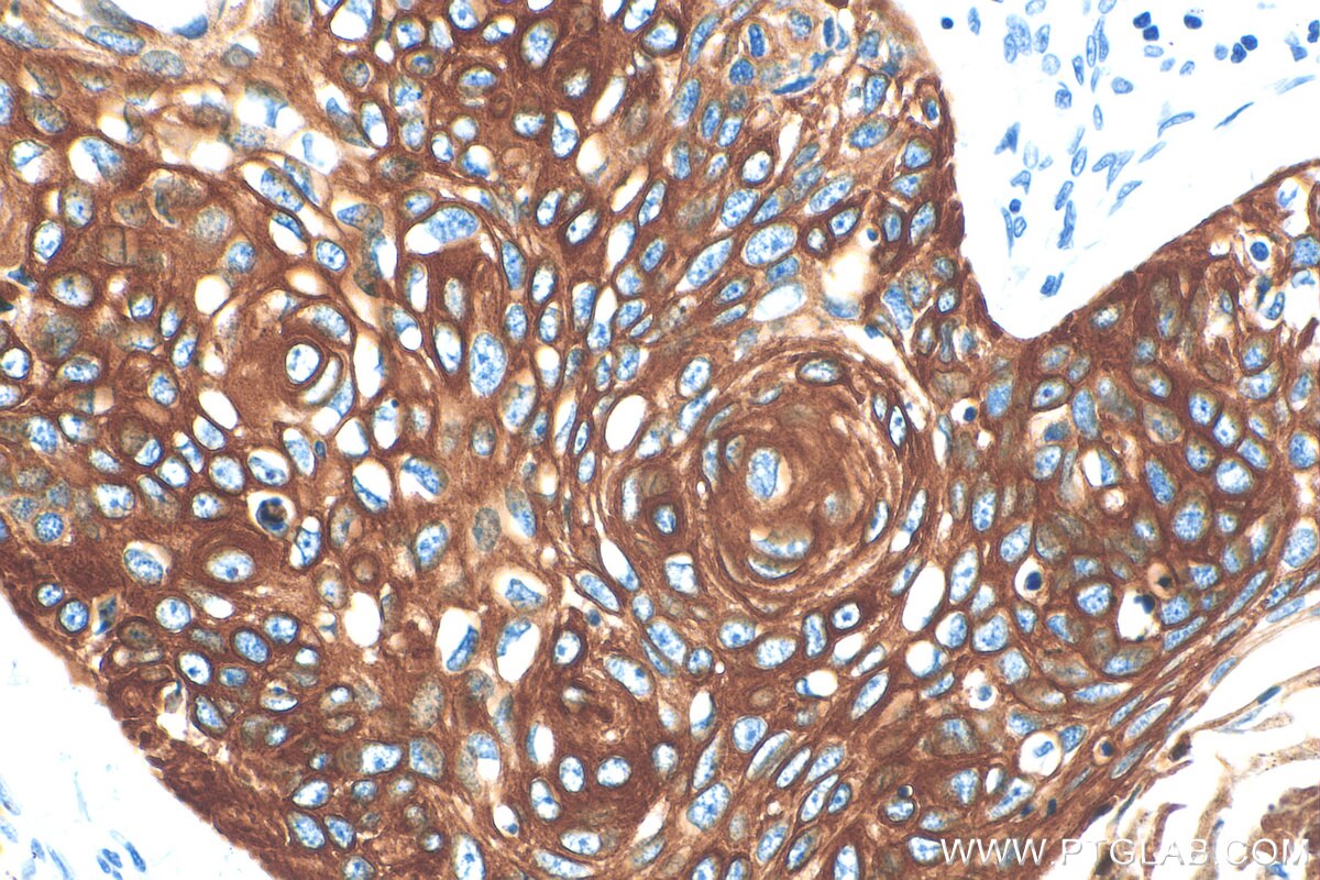 IHC staining of human oesophagus cancer using 83058-1-RR