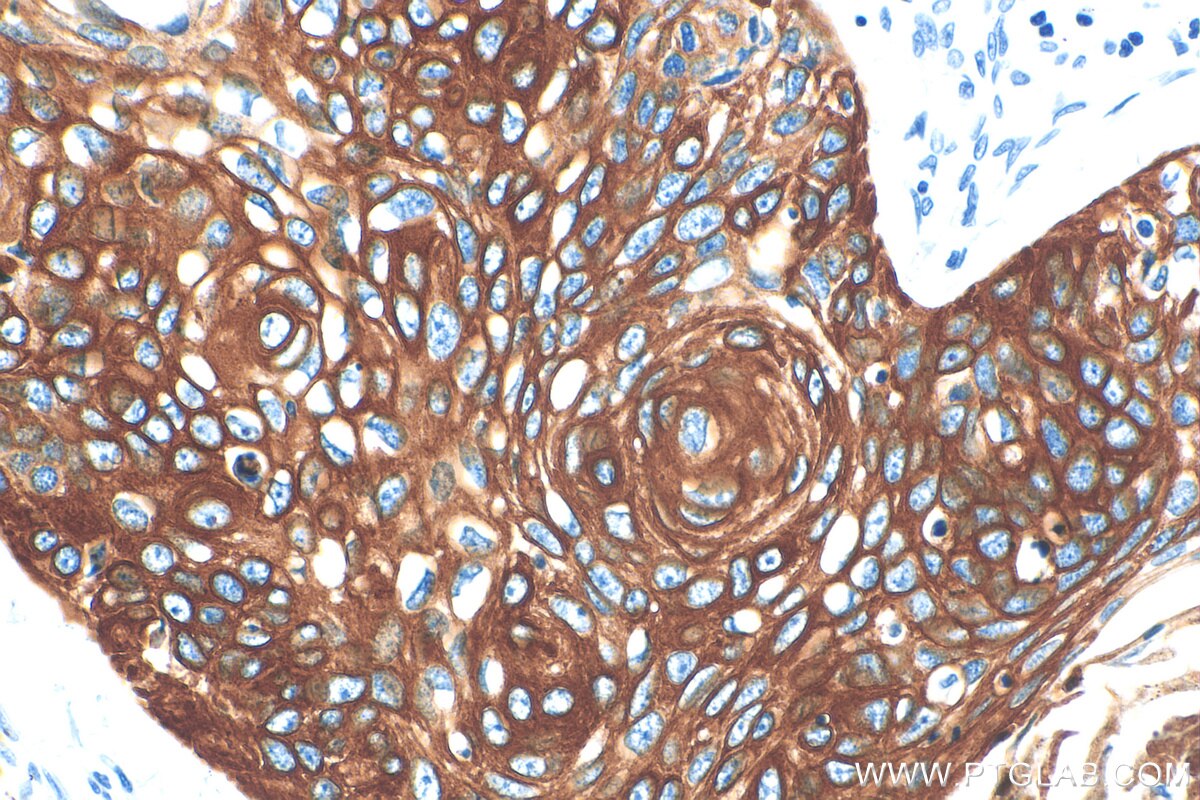 Immunohistochemistry (IHC) staining of human oesophagus cancer tissue using Cytokeratin 13 Recombinant antibody (83058-1-RR)