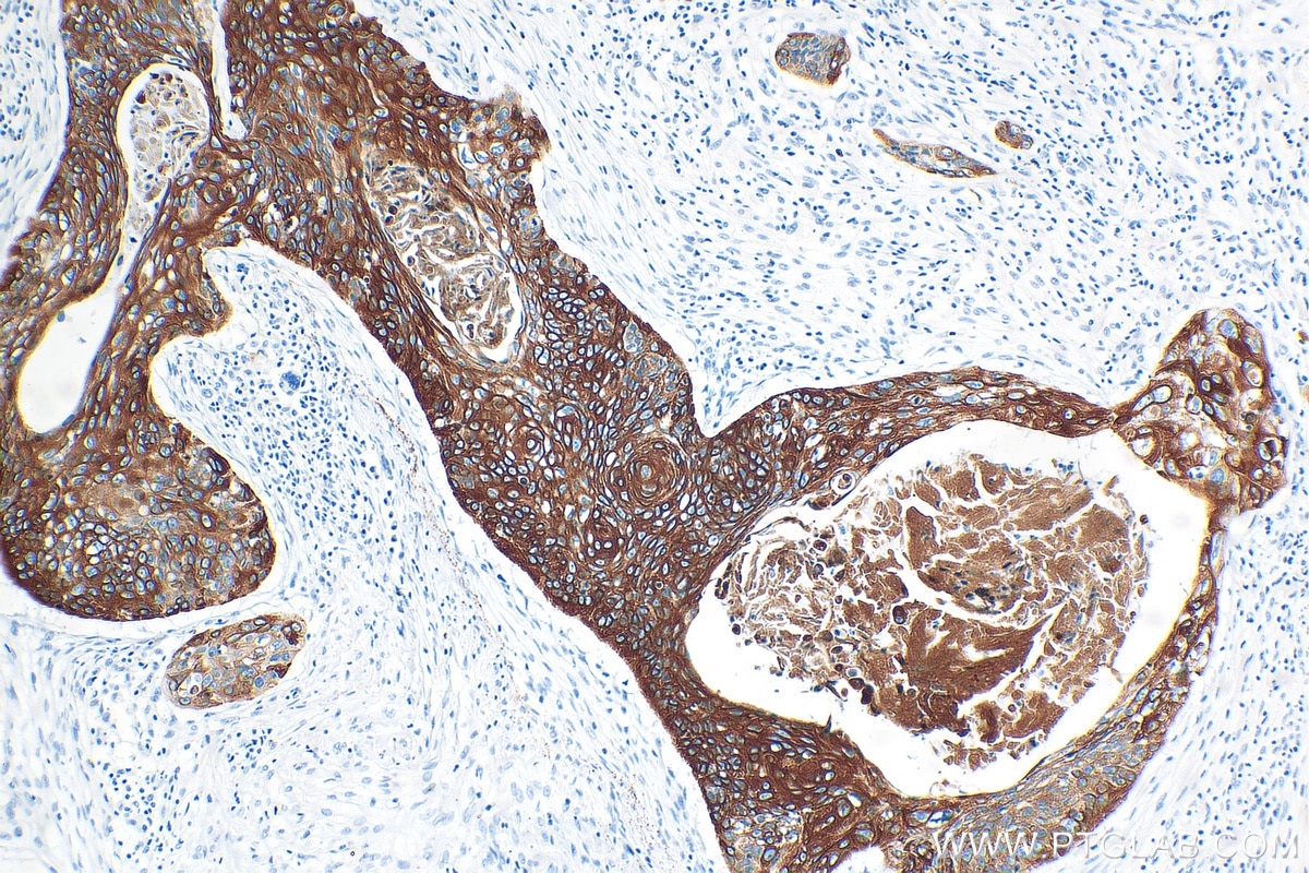 Immunohistochemistry (IHC) staining of human oesophagus cancer tissue using Cytokeratin 13 Recombinant antibody (83058-1-RR)