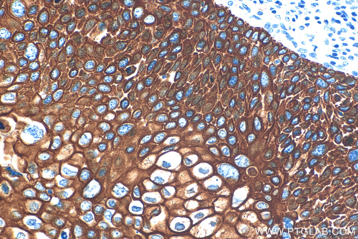 Immunohistochemistry (IHC) staining of human cervical cancer tissue using Cytokeratin 13 Recombinant antibody (83058-1-RR)