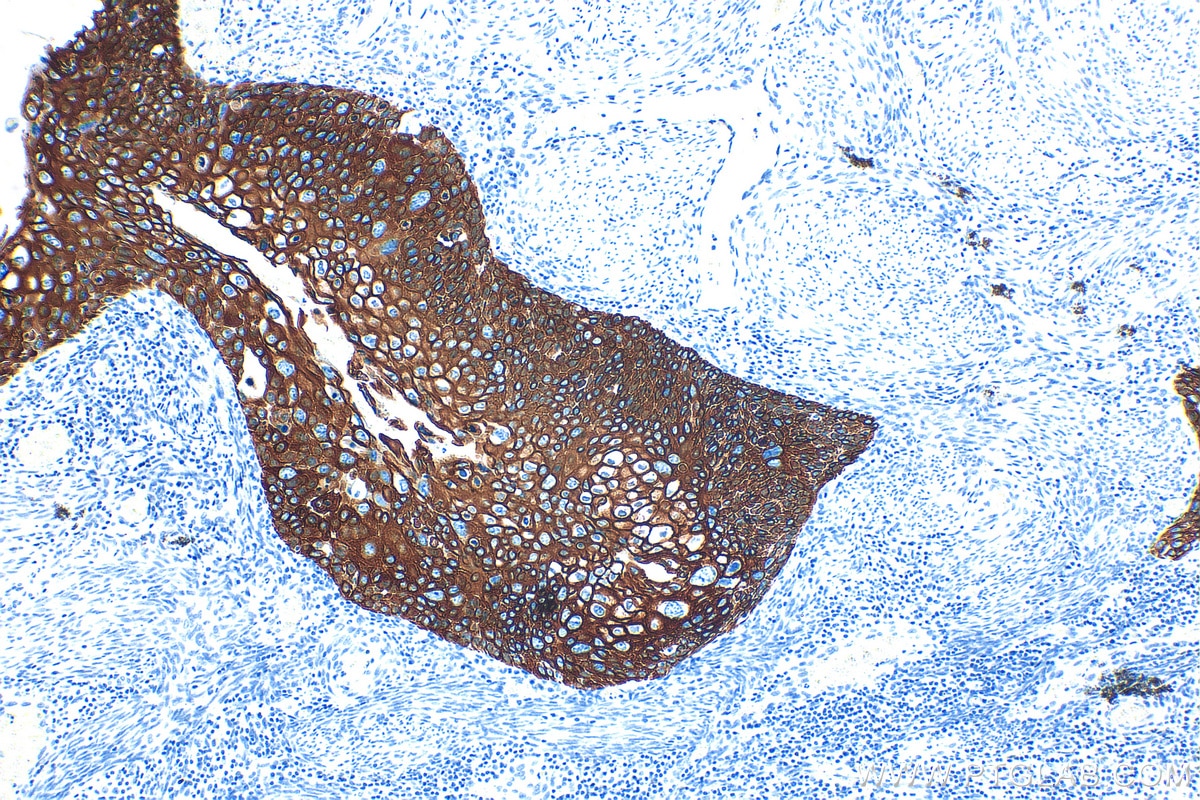 Immunohistochemistry (IHC) staining of human cervical cancer tissue using Cytokeratin 13 Recombinant antibody (83058-1-RR)