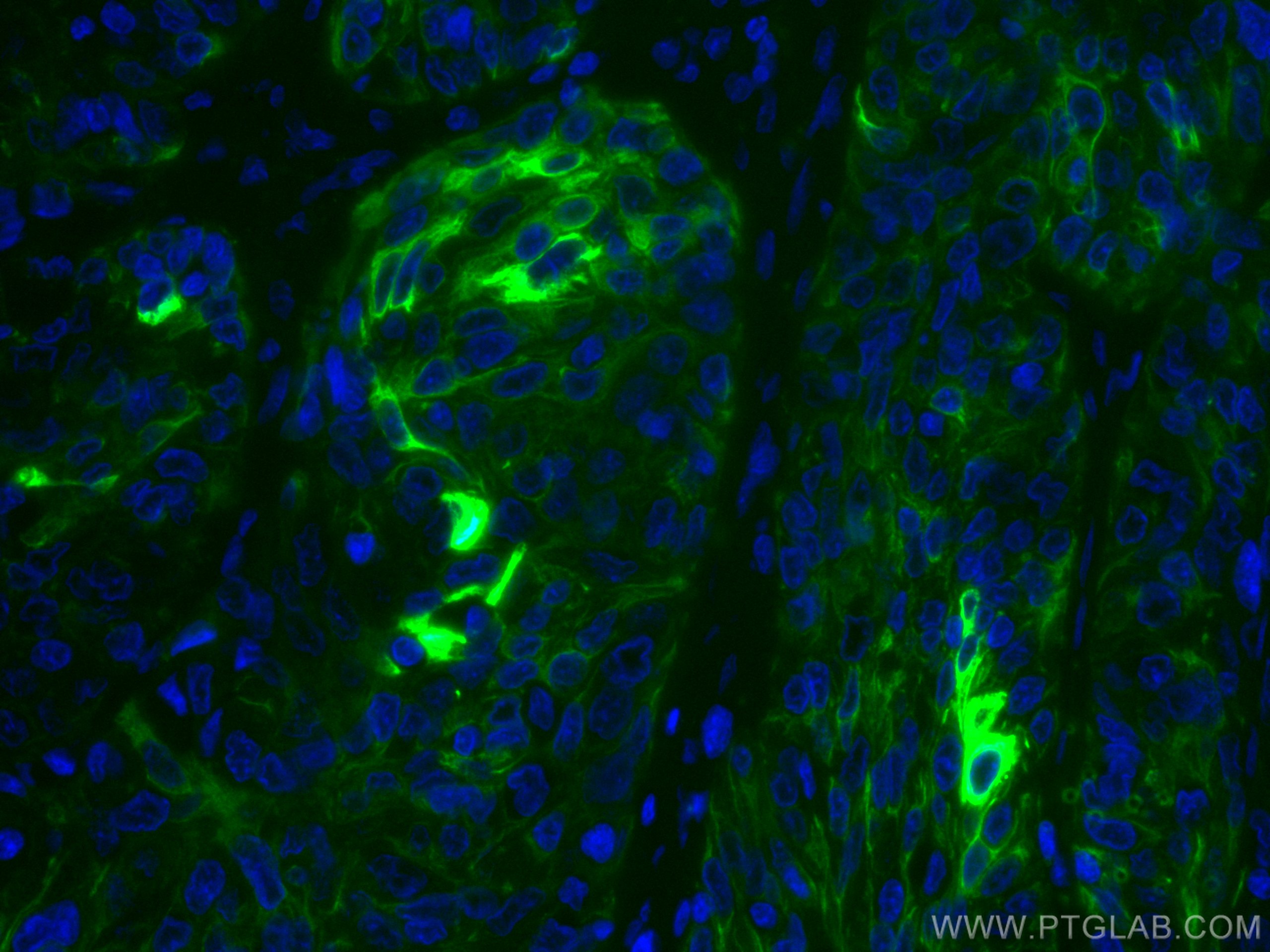 Immunofluorescence (IF) / fluorescent staining of human cervical cancer tissue using CoraLite® Plus 488-conjugated Cytokeratin 13 Monoc (CL488-66684)