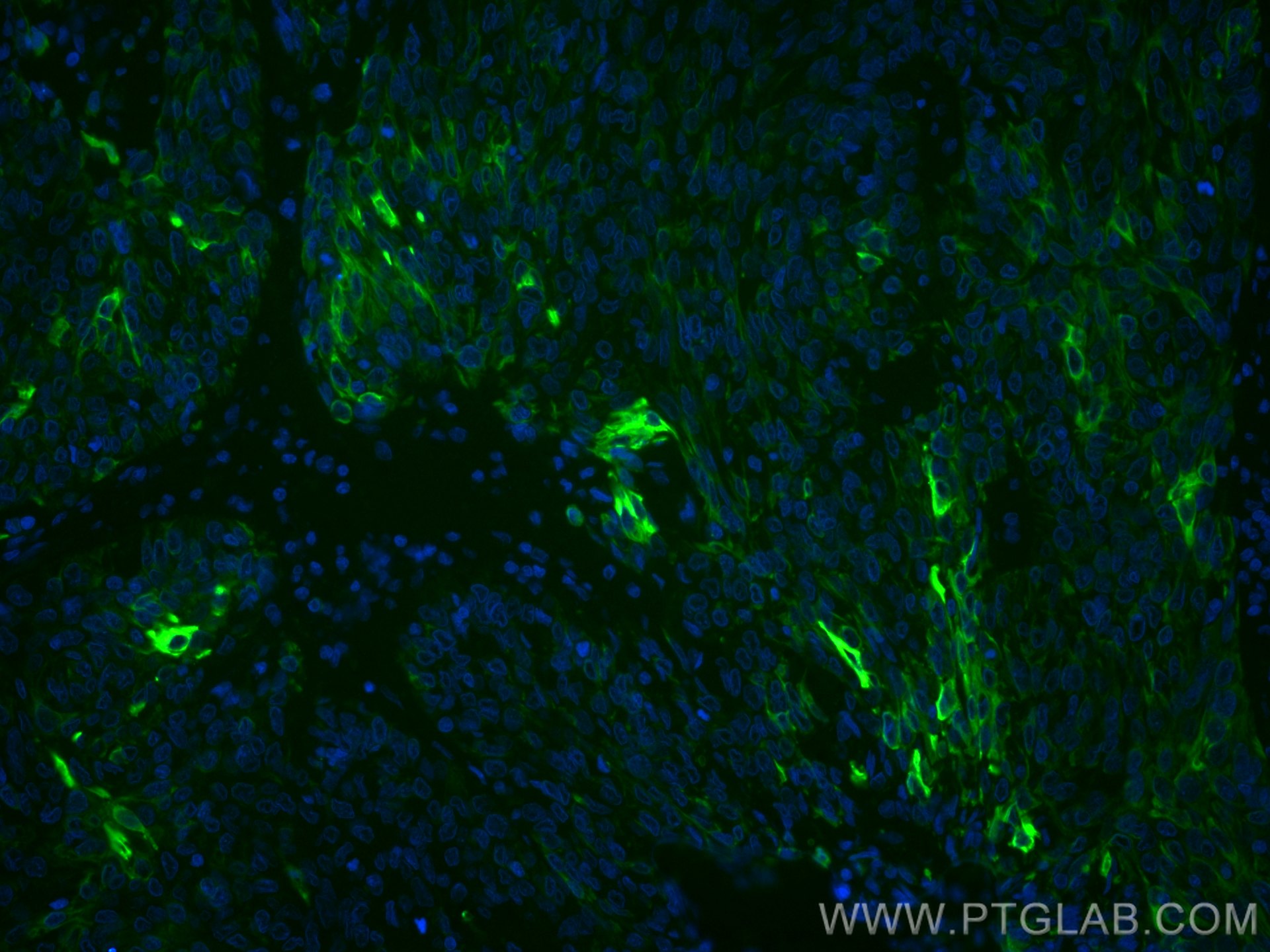 Immunofluorescence (IF) / fluorescent staining of human cervical cancer tissue using CoraLite® Plus 488-conjugated Cytokeratin 13 Monoc (CL488-66684)