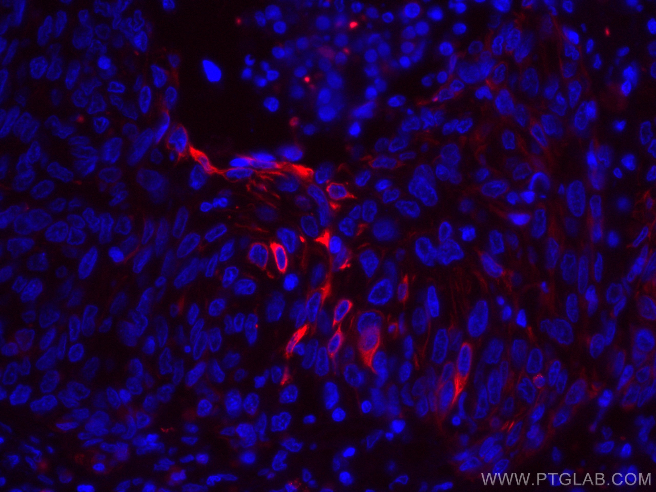Immunofluorescence (IF) / fluorescent staining of human cervical cancer tissue using CoraLite®594-conjugated Cytokeratin 13 Monoclonal  (CL594-66684)