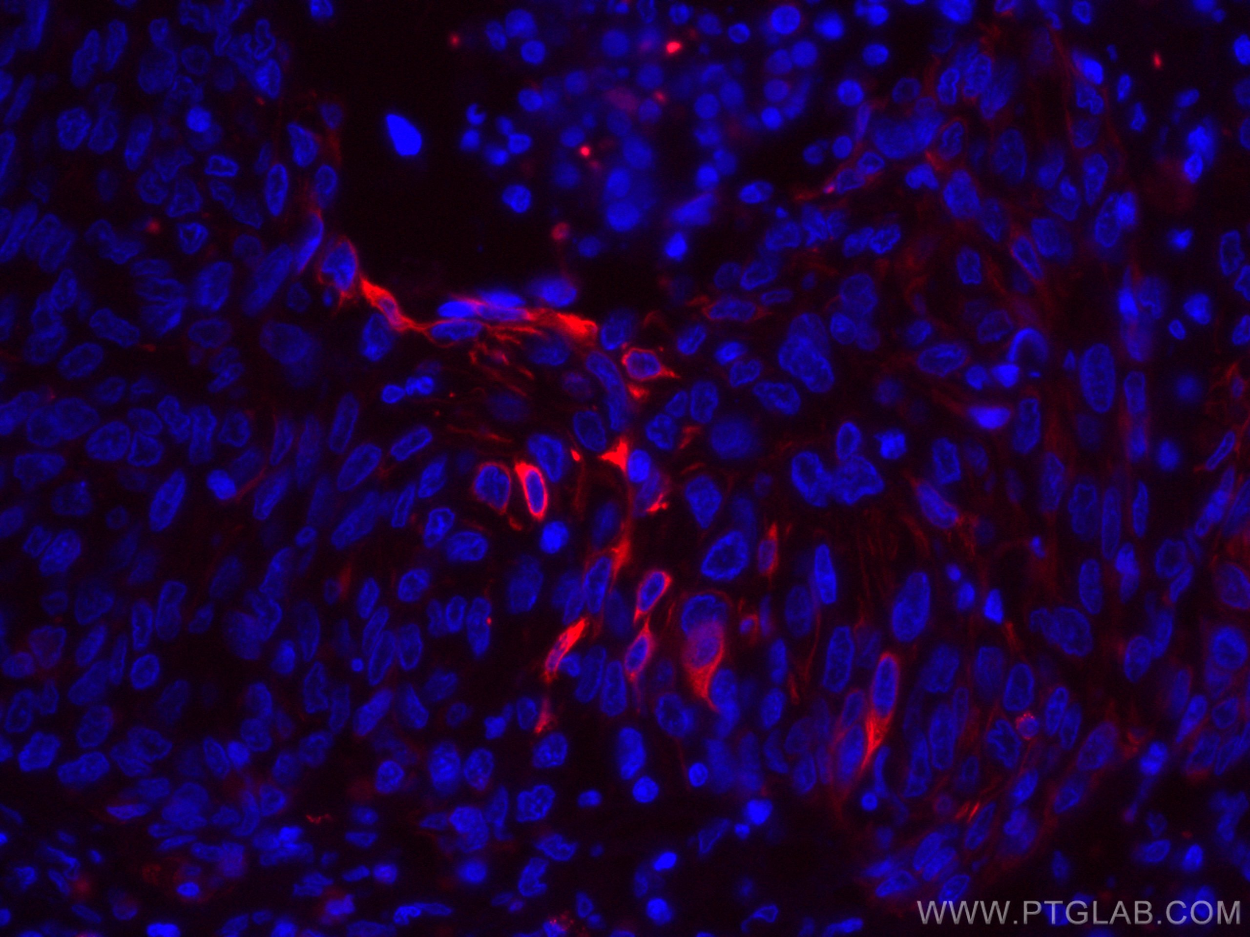 IF Staining of human cervical cancer using CL594-66684