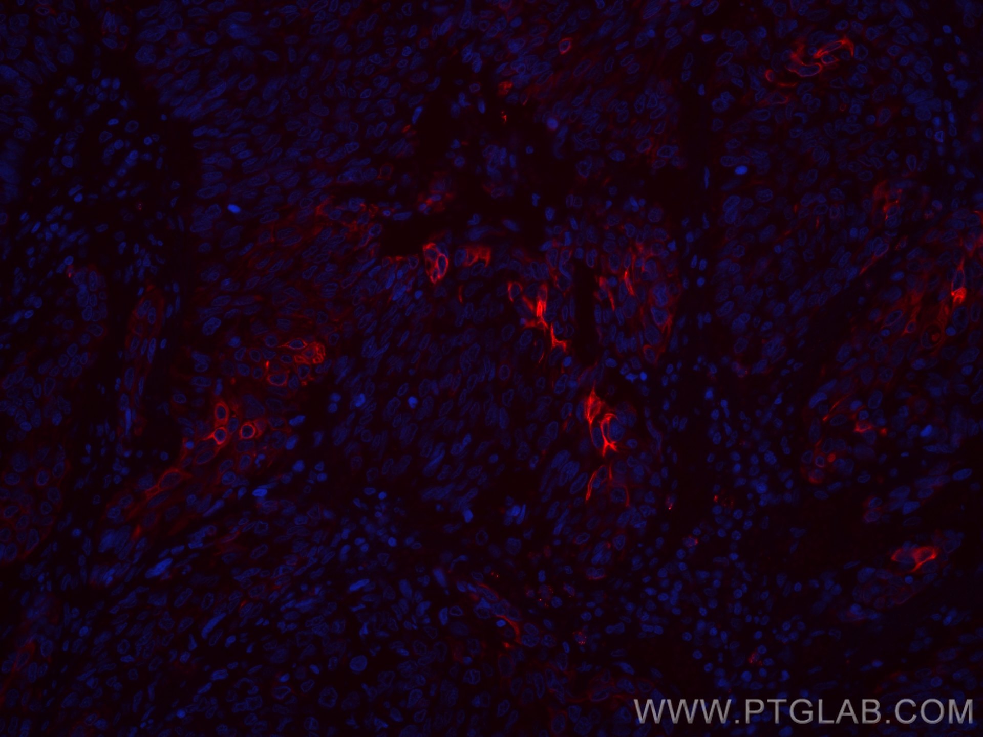 Immunofluorescence (IF) / fluorescent staining of human cervical cancer tissue using CoraLite®594-conjugated Cytokeratin 13 Monoclonal  (CL594-66684)