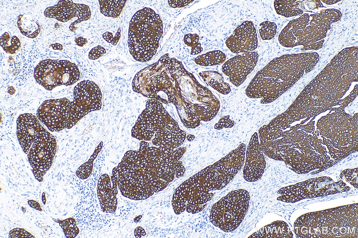 Immunohistochemistry (IHC) staining of human oesophagus cancer tissue using Cytokeratin 14 Recombinant antibody (82824-1-RR)