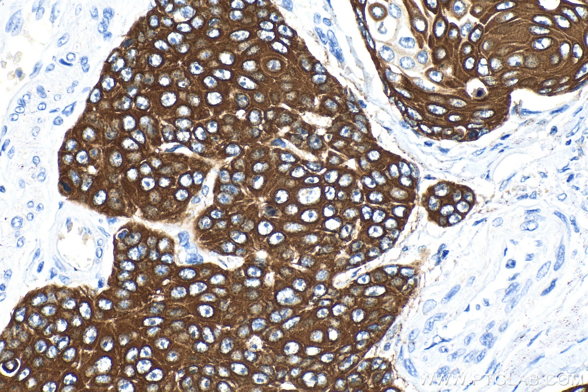 Immunohistochemistry (IHC) staining of human oesophagus cancer tissue using Cytokeratin 14 Recombinant antibody (82824-1-RR)