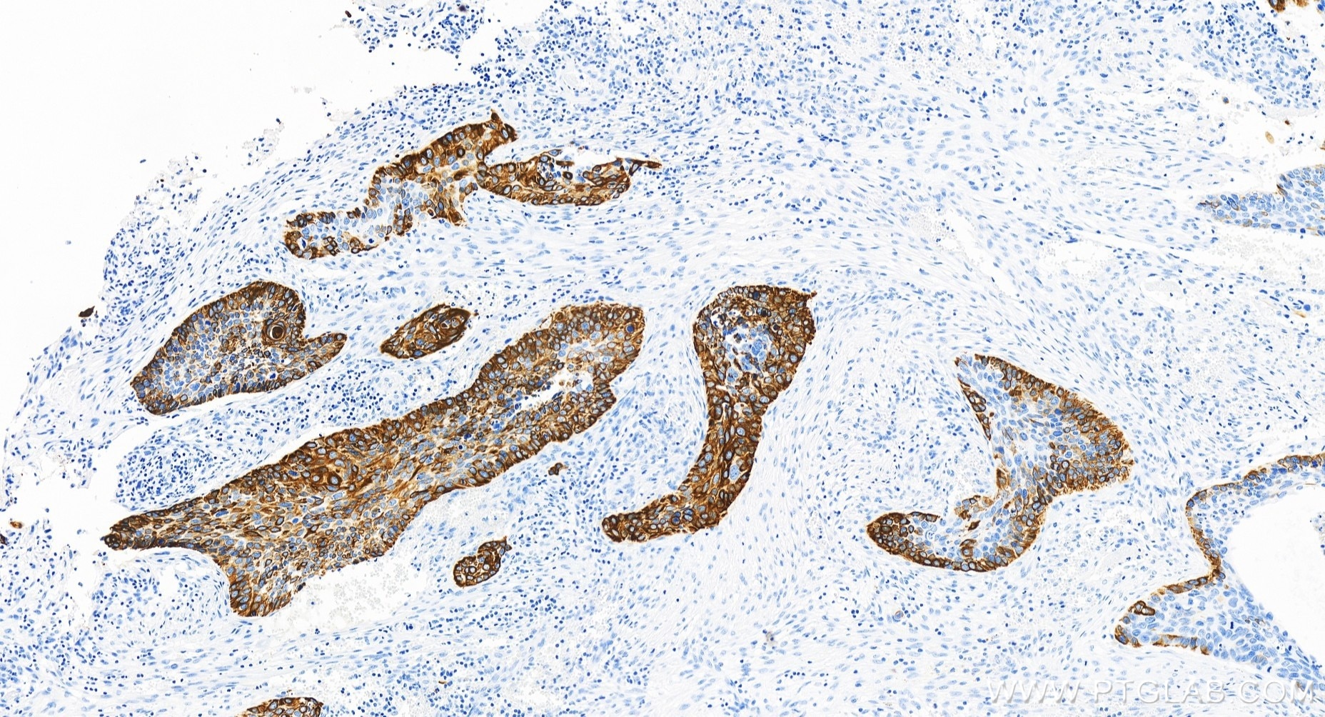 Immunohistochemistry (IHC) staining of human cervical cancer tissue using Cytokeratin 14 Recombinant antibody (83379-1-RR)