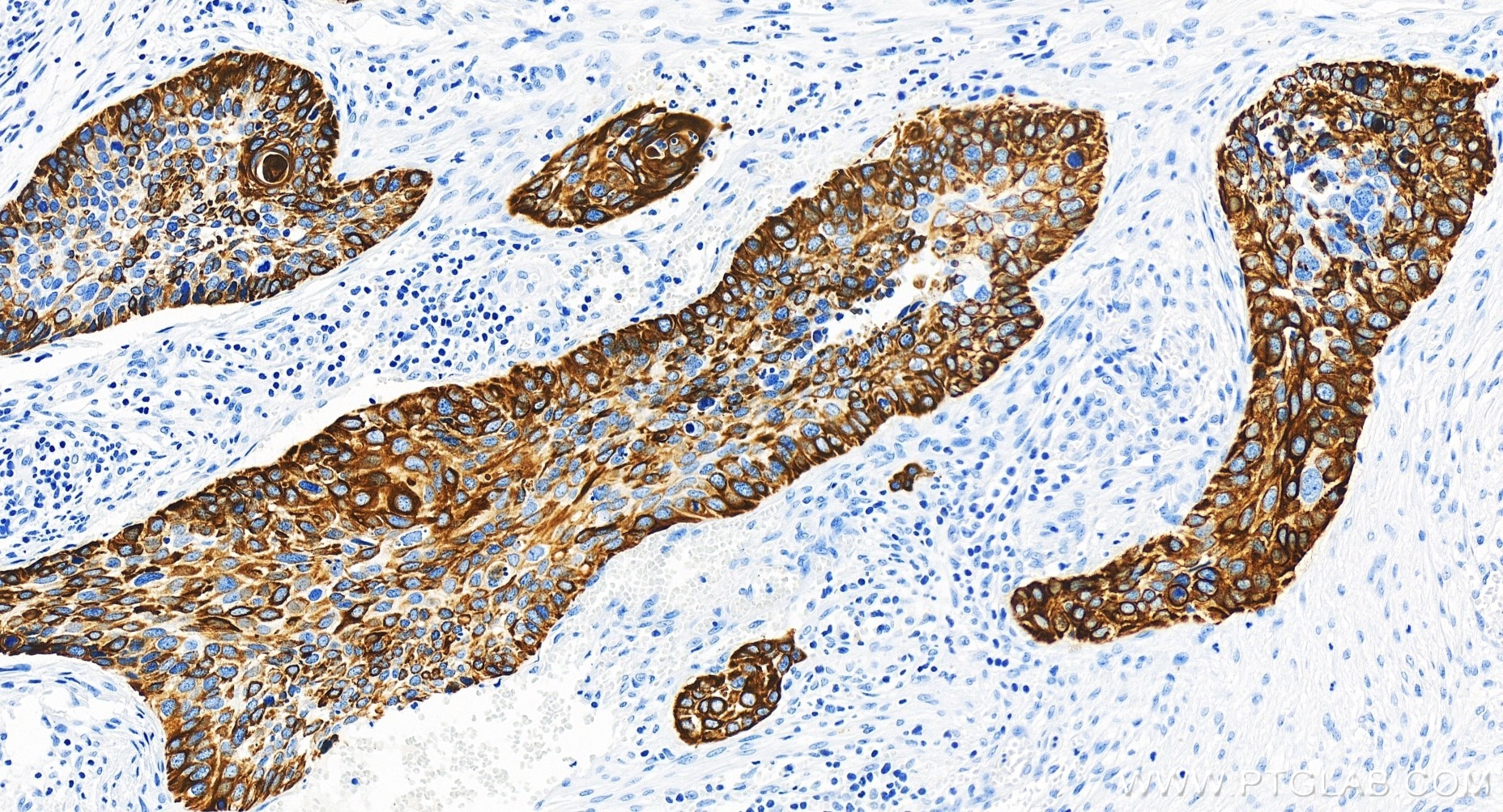 Immunohistochemistry (IHC) staining of human cervical cancer tissue using Cytokeratin 14 Recombinant antibody (83379-1-RR)