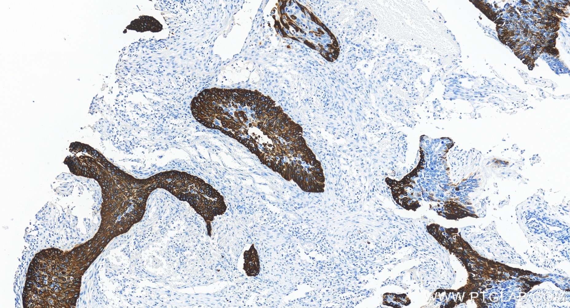 Immunohistochemical analysis of paraffin-embedded human cervical cancer tissue slide using 83379-1-RR (Cytokeratin 14 antibody) at dilution of 1:1000 (under 20x lens). Heat mediated antigen retrieval with Tris-EDTA buffer (pH 9.0). Immunohistochemistry (IHC) staining of human cervical cancer tissue using Cytokeratin 14 Recombinant monoclonal antibody (83379-1-RR)