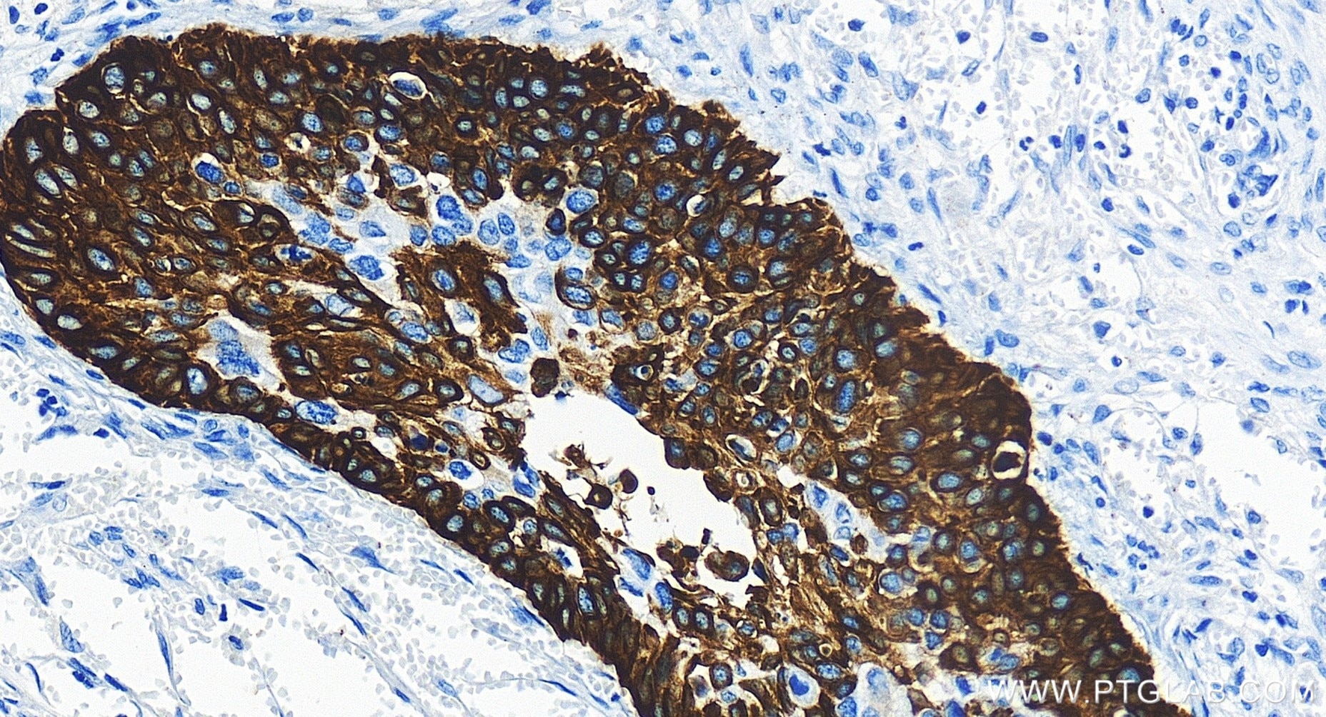 Immunohistochemical analysis of paraffin-embedded human cervical cancer tissue slide using 83379-1-RR (Cytokeratin 14 antibody) at dilution of 1:1000 (under 20x lens). Heat mediated antigen retrieval with Tris-EDTA buffer (pH 9.0). Immunohistochemistry (IHC) staining of human cervical cancer tissue using Cytokeratin 14 Recombinant monoclonal antibody (83379-1-RR)