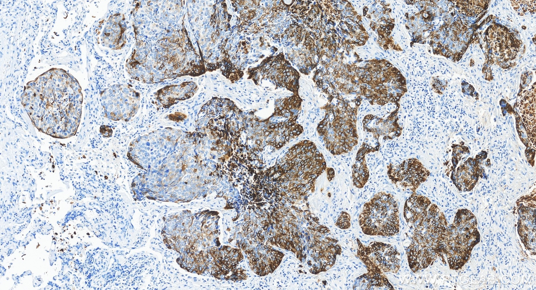 Immunohistochemical analysis of paraffin-embedded human lung cancer tissue slide using 83379-1-RR (Cytokeratin 14 antibody) at dilution of 1:1000 (under 20x lens). Heat mediated antigen retrieval with Tris-EDTA buffer (pH 9.0). Immunohistochemistry (IHC) staining of human lung cancer tissue using Cytokeratin 14 Recombinant monoclonal antibody (83379-1-RR)