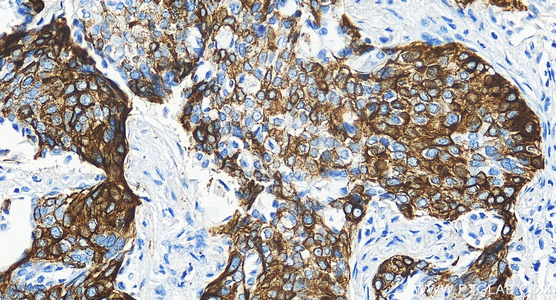 Immunohistochemical analysis of paraffin-embedded human lung cancer tissue slide using 83379-1-RR (Cytokeratin 14 antibody) at dilution of 1:1000 (under 20x lens). Heat mediated antigen retrieval with Tris-EDTA buffer (pH 9.0). Immunohistochemistry (IHC) staining of human lung cancer tissue using Cytokeratin 14 Recombinant monoclonal antibody (83379-1-RR)