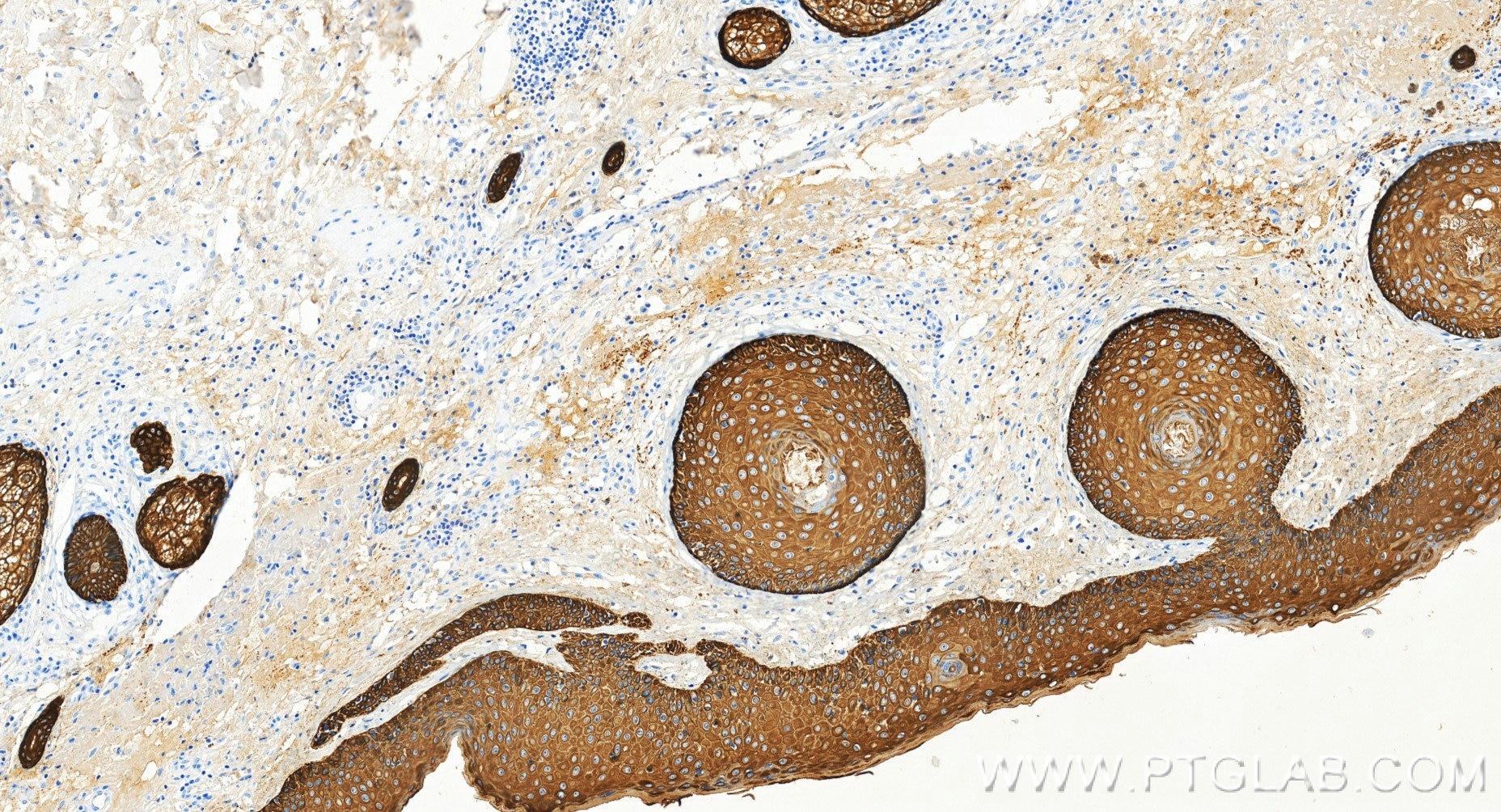 Immunohistochemistry (IHC) staining of human skin tissue using Cytokeratin 14 Recombinant monoclonal antibody (83379-1-RR)