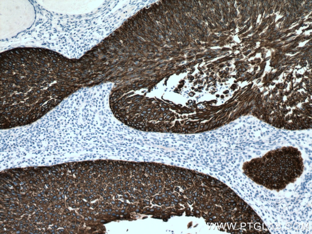Immunohistochemistry (IHC) staining of human cervical cancer tissue using Cytokeratin 16 Monoclonal antibody (66802-1-Ig)