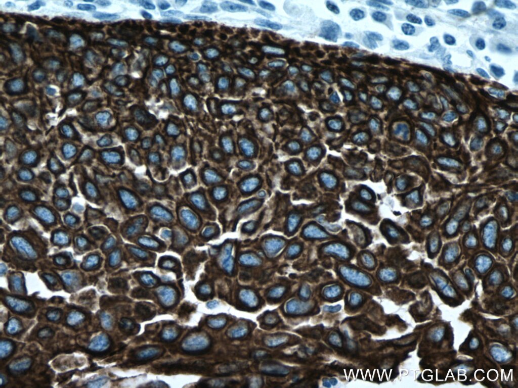 Immunohistochemistry (IHC) staining of human cervical cancer tissue using Cytokeratin 16 Monoclonal antibody (66802-1-Ig)