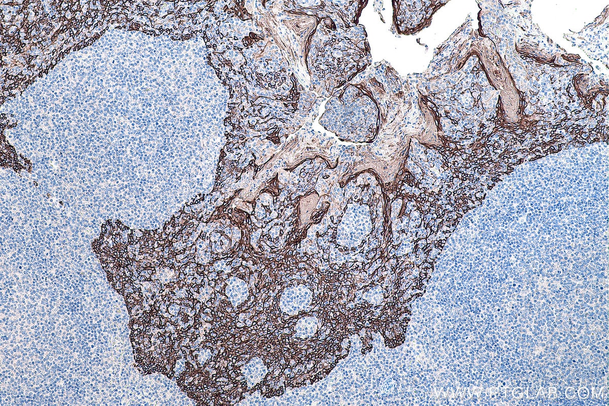 Immunohistochemistry (IHC) staining of human tonsillitis tissue using Cytokeratin 16 Monoclonal antibody (66802-1-Ig)