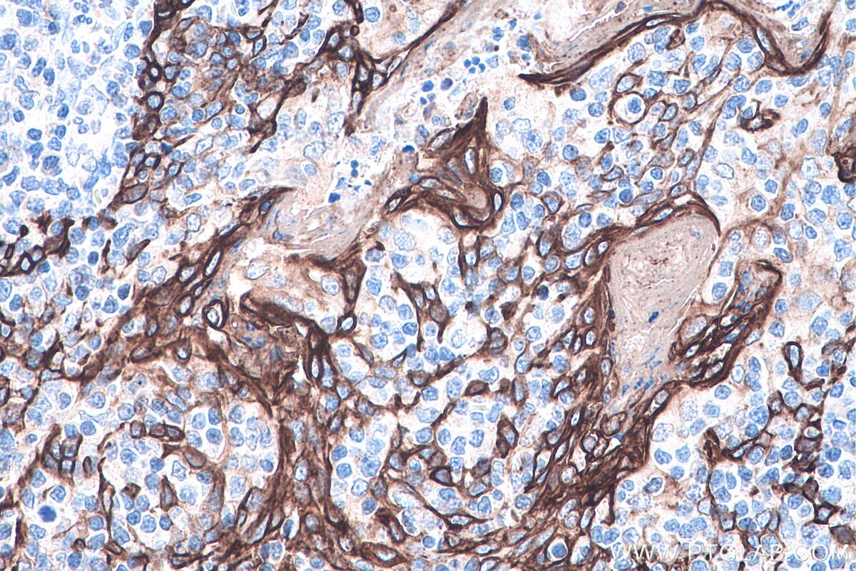 Immunohistochemistry (IHC) staining of human tonsillitis tissue using Cytokeratin 16 Monoclonal antibody (66802-1-Ig)