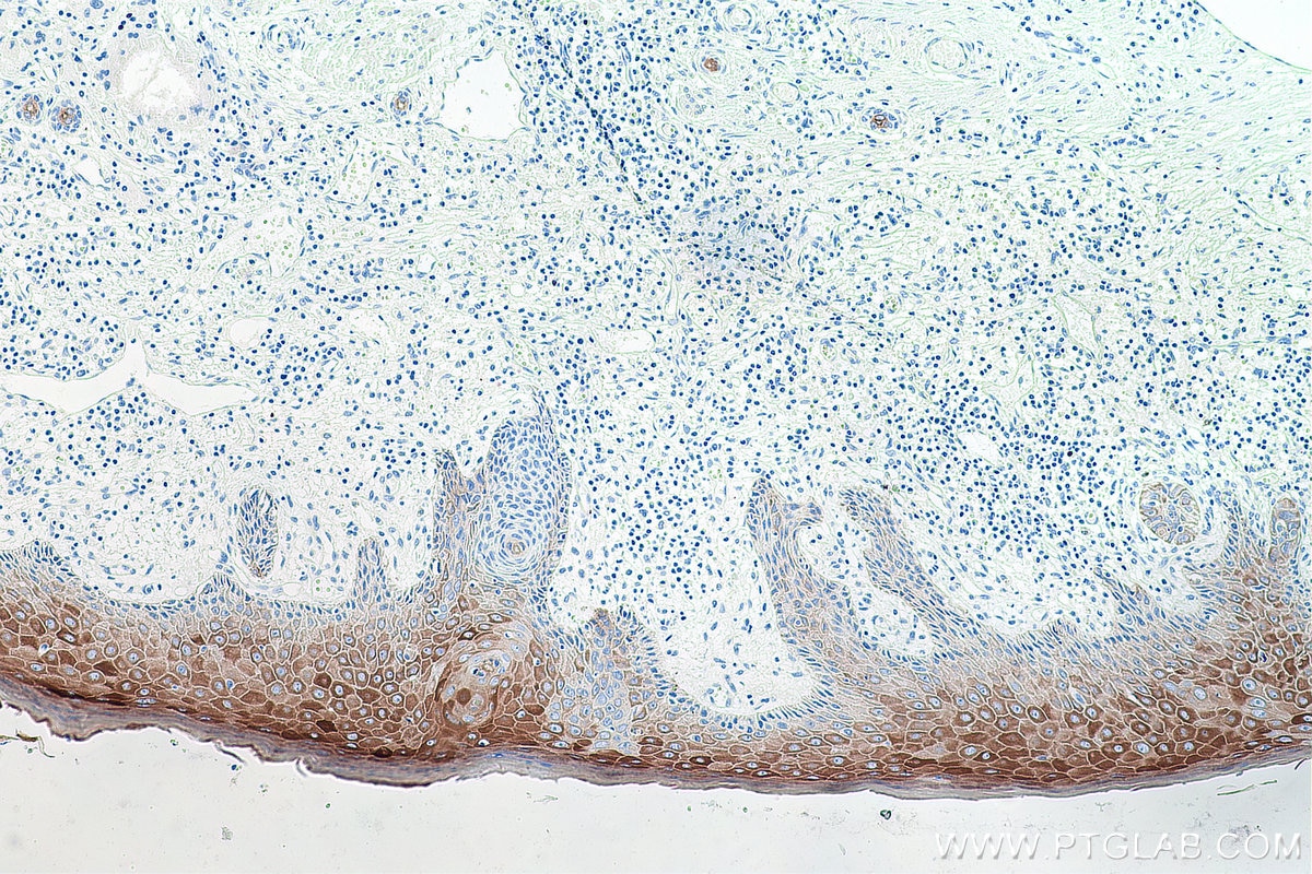Immunohistochemistry (IHC) staining of human skin cancer tissue using Cytokeratin 16 Monoclonal antibody (66802-1-Ig)