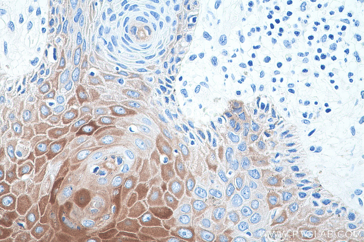 Immunohistochemistry (IHC) staining of human skin cancer tissue using Cytokeratin 16 Monoclonal antibody (66802-1-Ig)