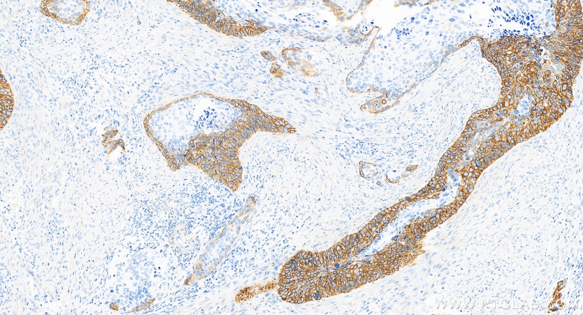 Immunohistochemistry (IHC) staining of human cervical cancer tissue using Cytokeratin 17-specific Recombinant antibody (84978-1-RR)