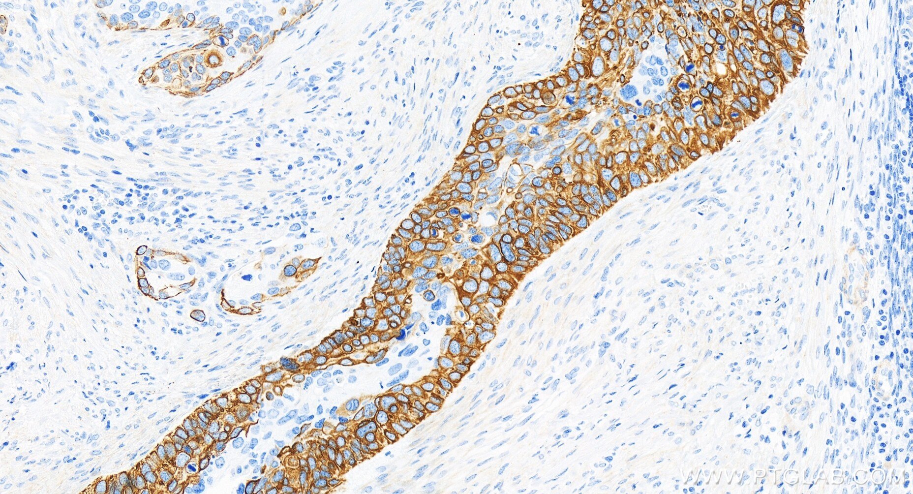 Immunohistochemistry (IHC) staining of human cervical cancer tissue using Cytokeratin 17-specific Recombinant antibody (84978-1-RR)