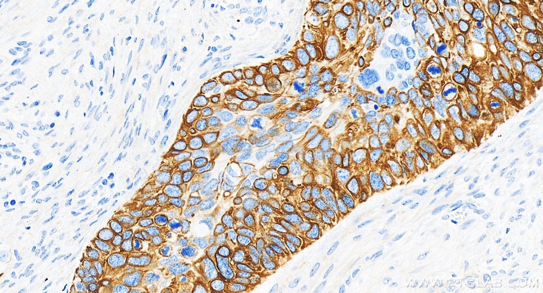 Immunohistochemistry (IHC) staining of human cervical cancer tissue using Cytokeratin 17-specific Recombinant antibody (84978-1-RR)