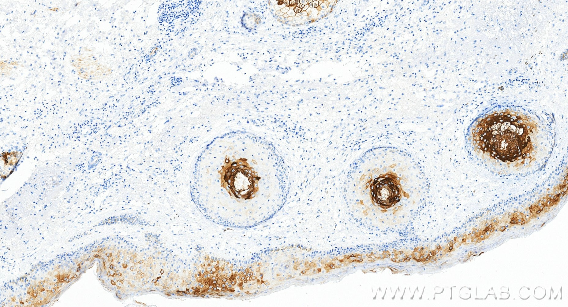 Immunohistochemistry (IHC) staining of human skin tissue using Cytokeratin 17-specific Recombinant monoclonal ant (84978-1-RR)
