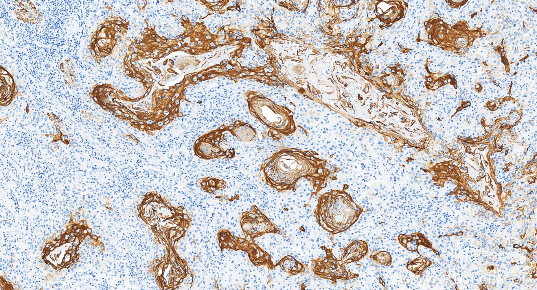 Immunohistochemistry (IHC) staining of human skin cancer tissue using Cytokeratin 17-specific Recombinant antibody (84978-1-RR)
