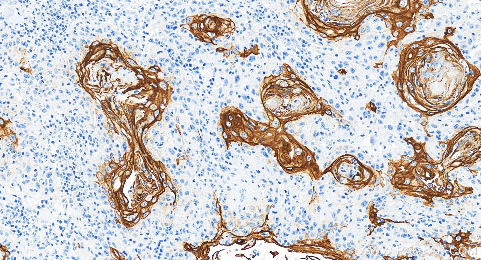 Immunohistochemistry (IHC) staining of human skin cancer tissue using Cytokeratin 17-specific Recombinant antibody (84978-1-RR)