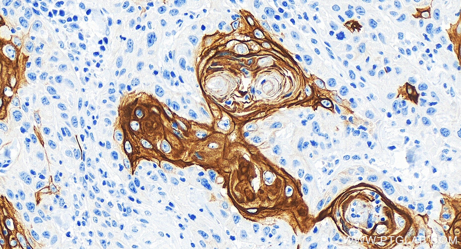 Immunohistochemistry (IHC) staining of human skin cancer tissue using Cytokeratin 17-specific Recombinant antibody (84978-1-RR)