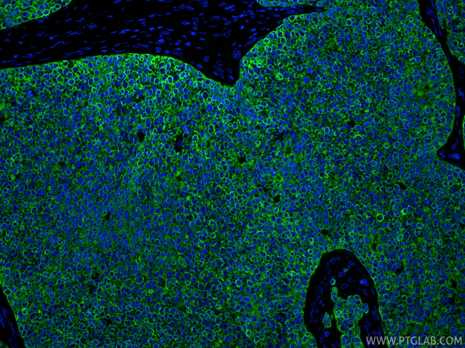 IF Staining of human breast cancer using 29855-1-AP Immunofluorescence (IF) / fluorescent staining of human breast cancer tissue using Cytokeratin 19 Polyclonal antibody (29855-1-AP)