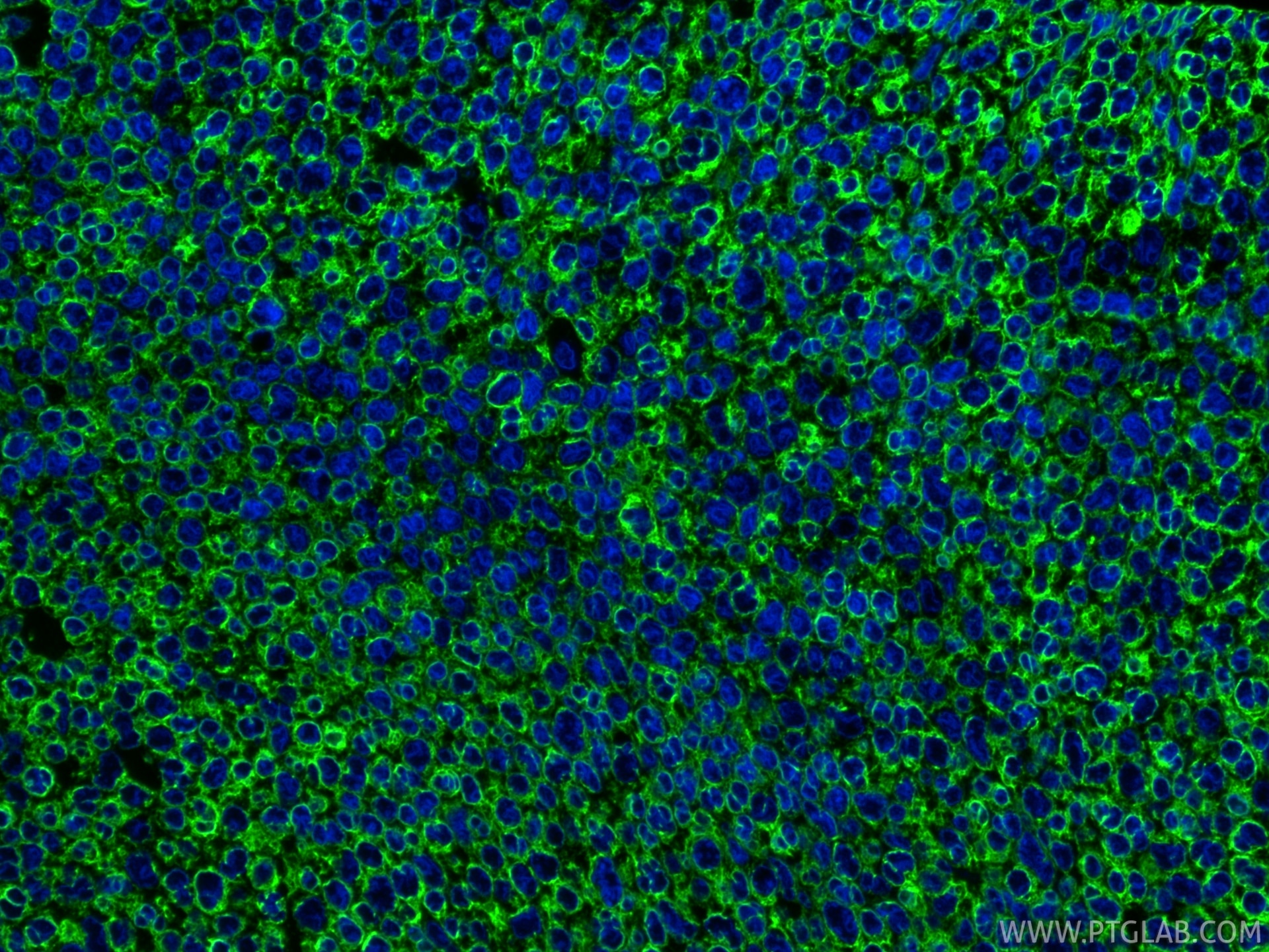 IF Staining of human breast cancer using 29855-1-AP Immunofluorescence (IF) / fluorescent staining of human breast cancer tissue using Cytokeratin 19 Polyclonal antibody (29855-1-AP)