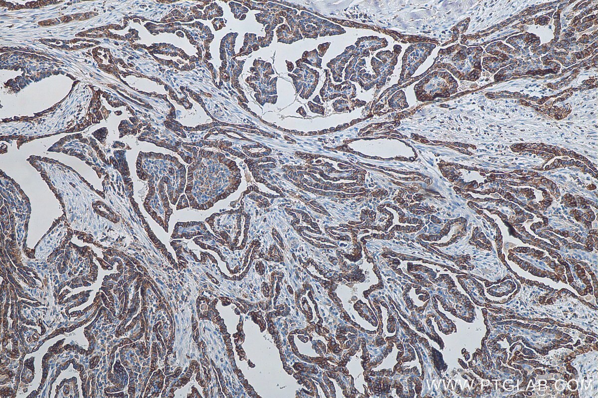 Immunohistochemistry (IHC) staining of human thyroid cancer tissue using Cytokeratin 19 Polyclonal antibody (29855-1-AP)