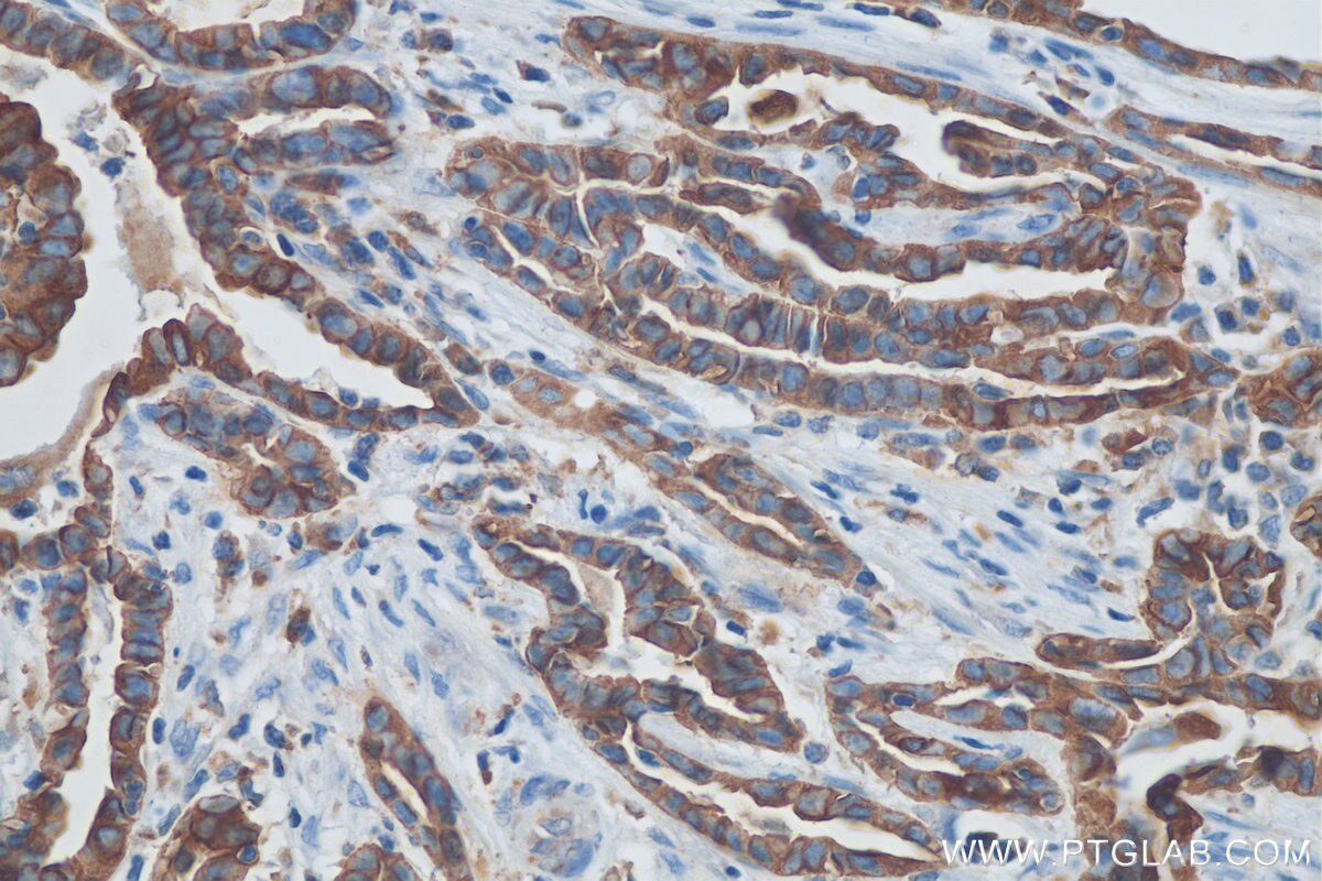 Immunohistochemistry (IHC) staining of human thyroid cancer tissue using Cytokeratin 19 Polyclonal antibody (29855-1-AP)