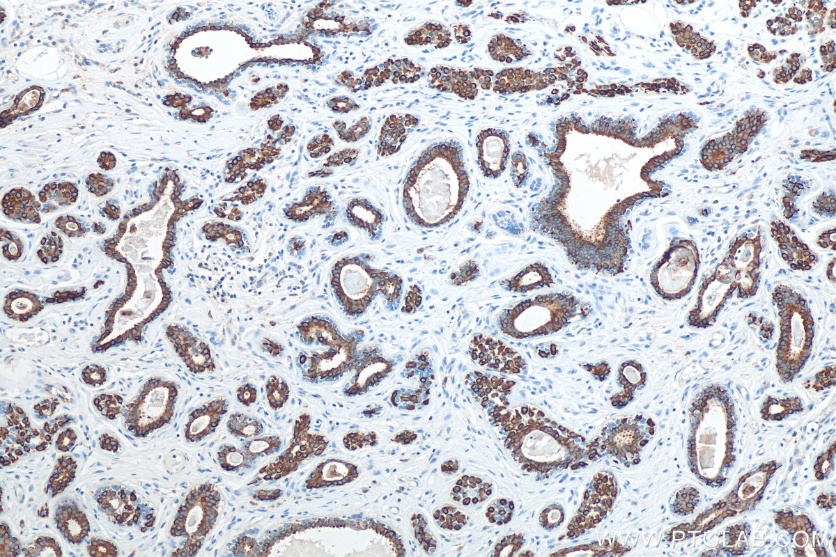 Immunohistochemistry (IHC) staining of human breast cancer tissue using Cytokeratin 19 Polyclonal antibody (29855-1-AP)