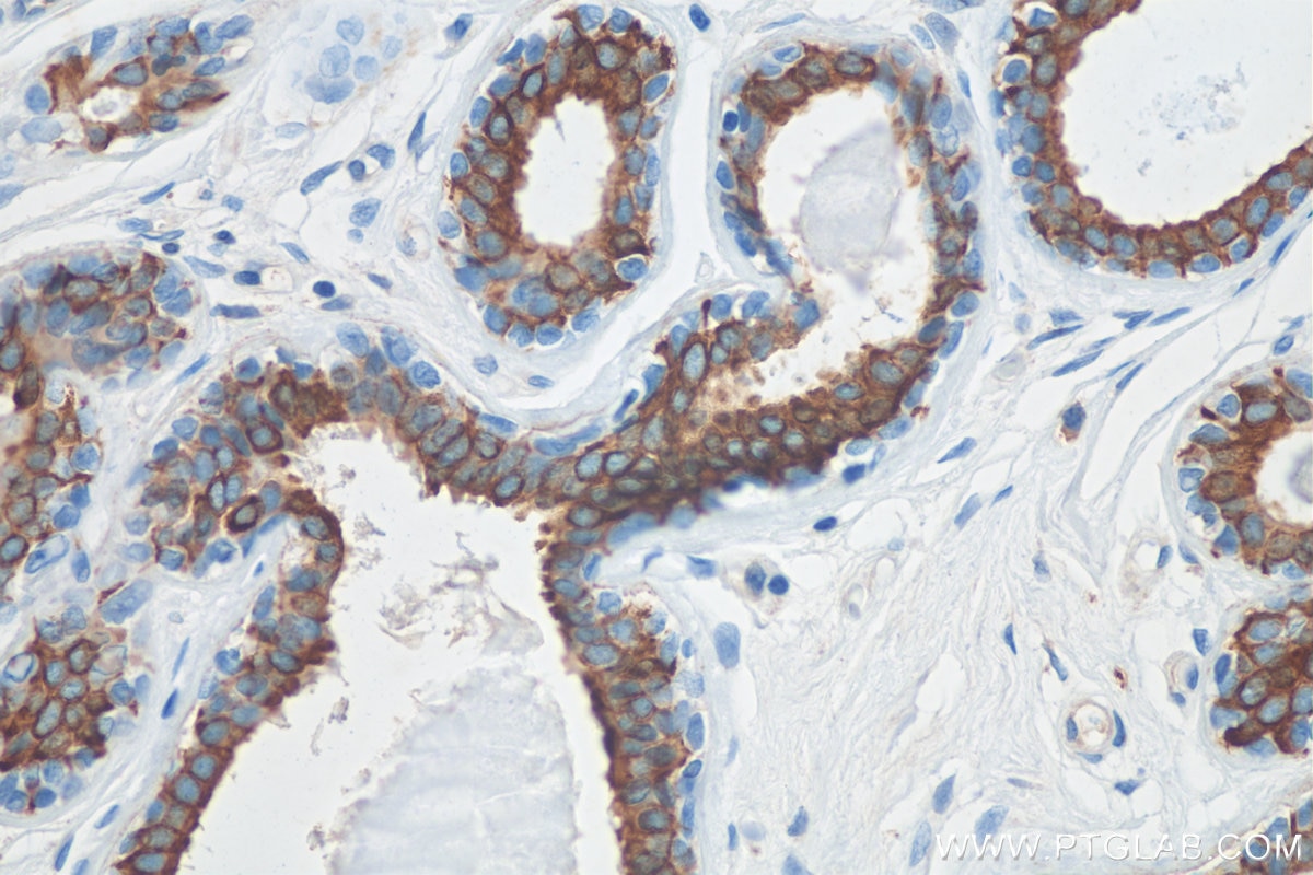 Immunohistochemistry (IHC) staining of human breast cancer tissue using Cytokeratin 19 Polyclonal antibody (29855-1-AP)