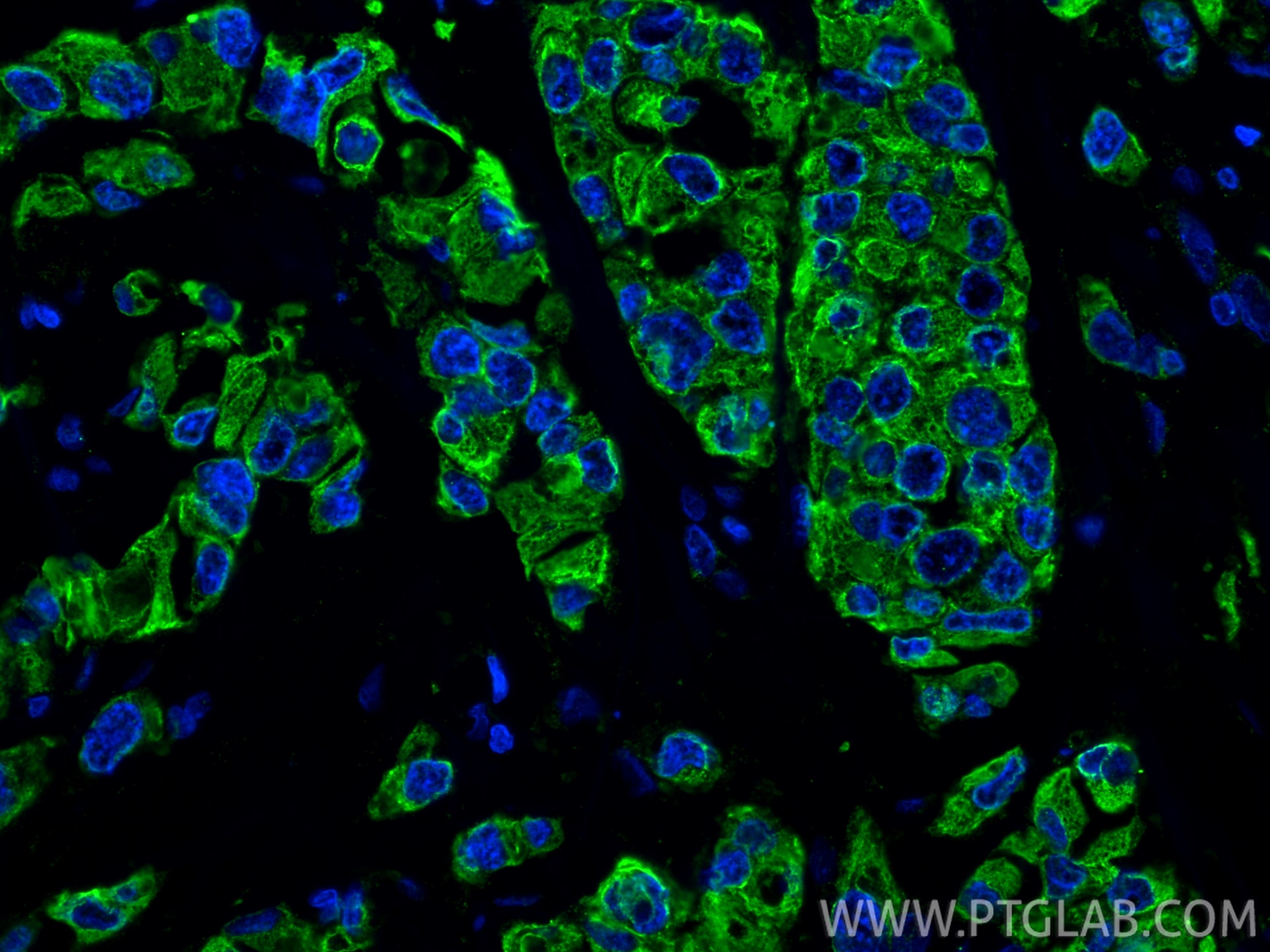 Immunofluorescence (IF) / fluorescent staining of human breast cancer tissue using Cytokeratin 19 Recombinant antibody (86250-1-RR)