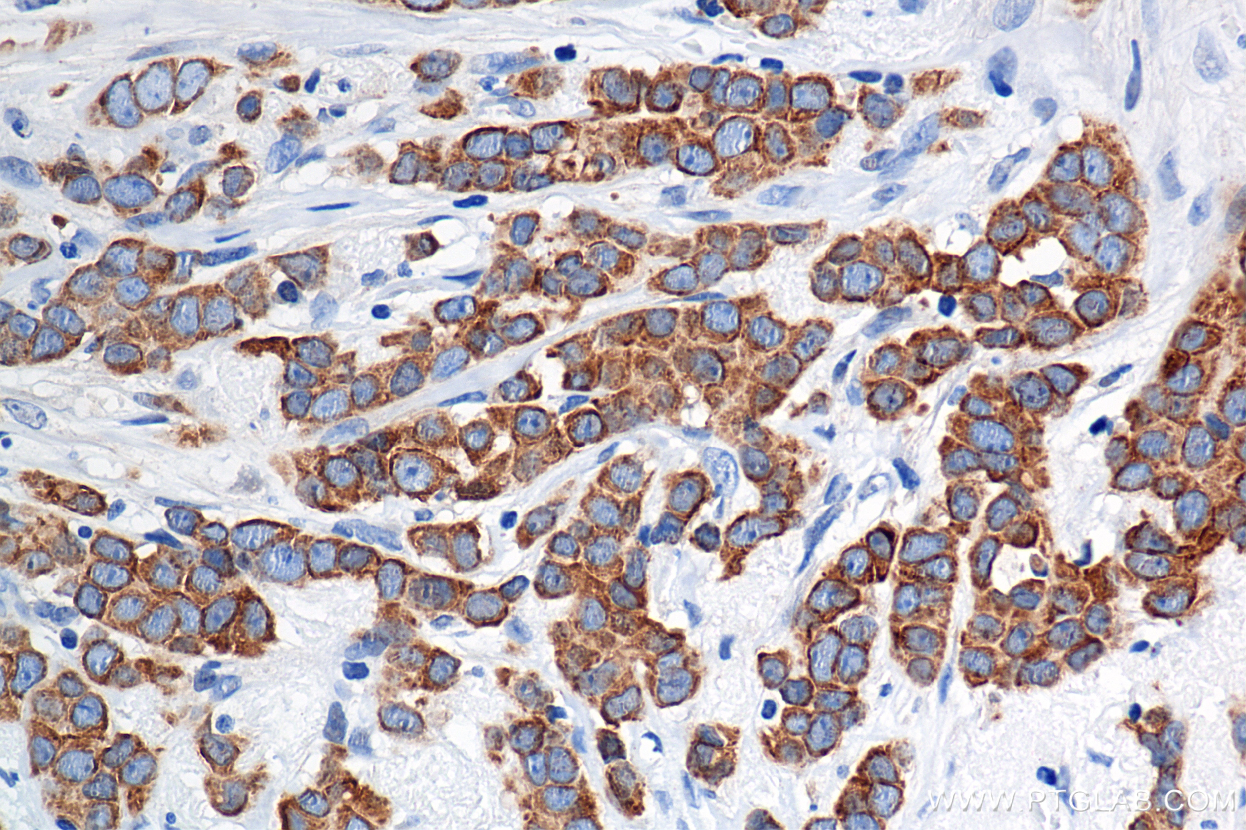 Immunohistochemistry (IHC) staining of human breast cancer tissue using Cytokeratin 19 Recombinant antibody (86250-1-RR)